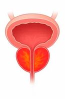 Prostat bezinin iltihabı